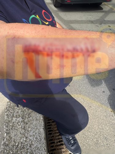 (OPREZ) UZNEMIRUJUĆE FOTOGRAFIJE IZMASAKRIRANE RUKE SAŠE MIRKOVIĆA: Evo kako izgleda RUKA čelnika Hype televizije nakon KRVNIČKOG POKUŠAJA UBISTVA